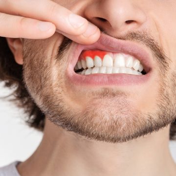 Un homme présente des signes de maladies gingivales, dont le traitement relève de la parodontie