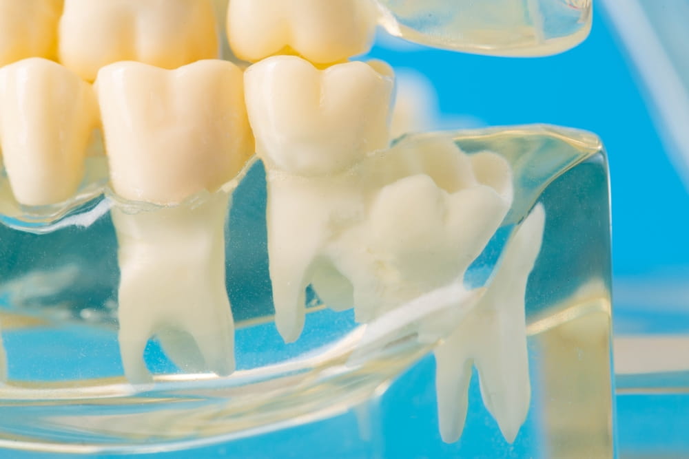 Les dents de sagesse qui font pression sur les molaires voisines